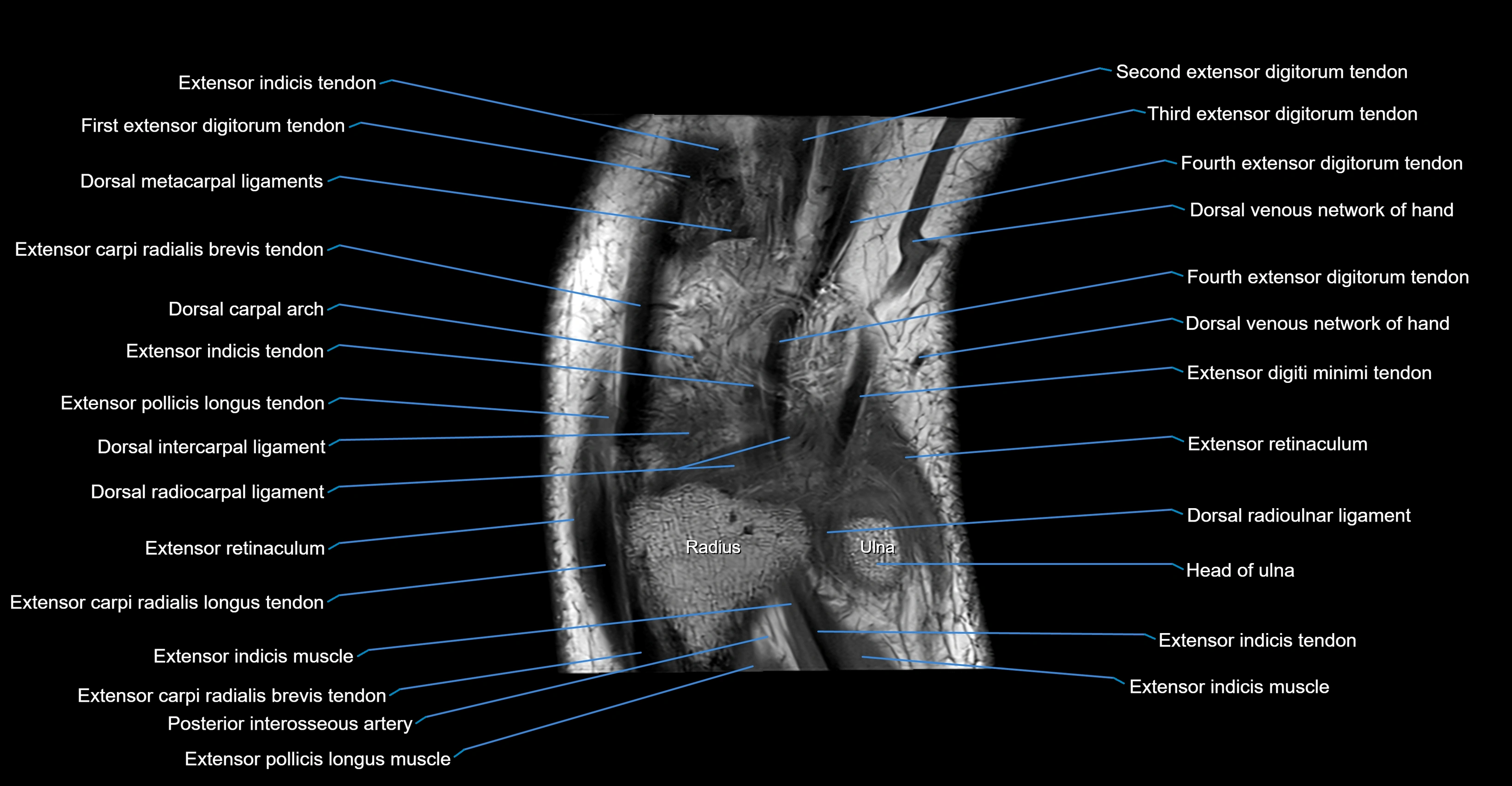 MRI wrist coronal cross sectional anatomy 3T  radiology  image-img-00001-00008.webp